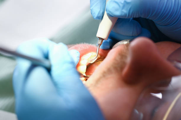 Best Dental Abscess Treatment in Double Springs, AL